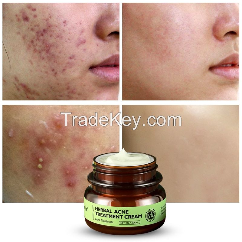 Herbal Acne Treatment Extra Strength Acne Pimple Cream & Lotion