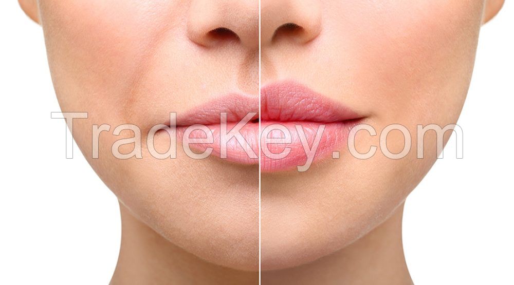 Dermal Filler, Dermal Fillers