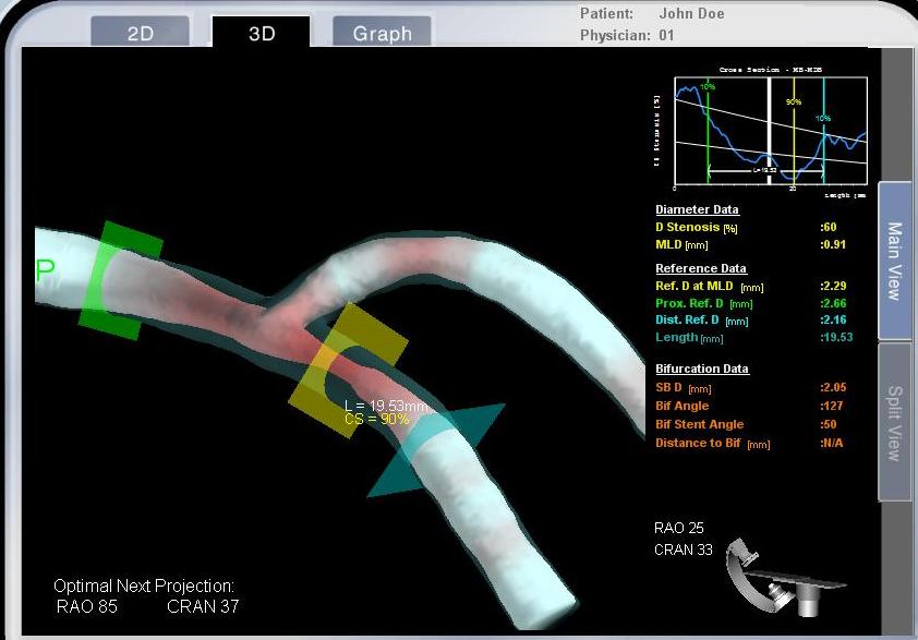 3Dimensional Imaging System for The Recosntruction and analysis of Cor