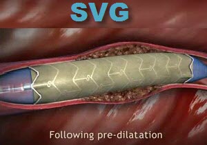 Pericardium Covered Stent