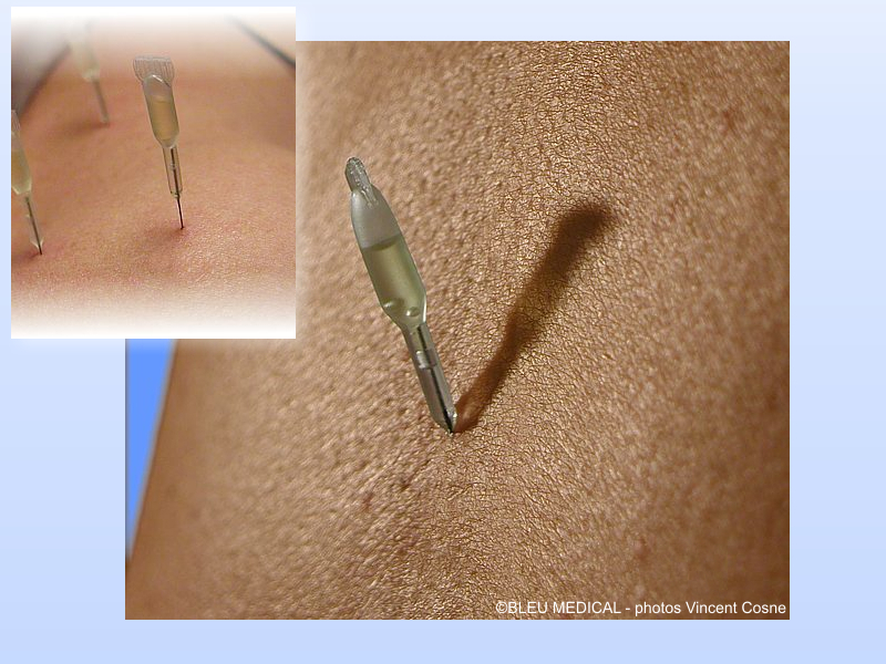 DISPOSABLE DEVICE FOR MESOTHERAPY and Acupuncture/*Mesopuncture