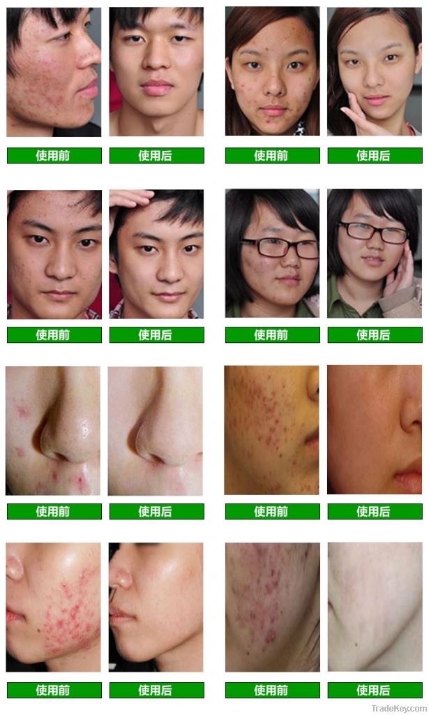acne removal( CE RoHS)