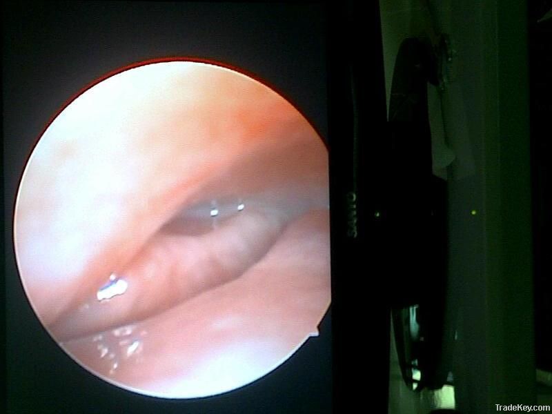 Endoscope.sinuscope