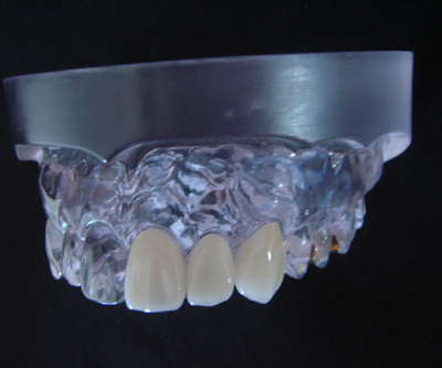 Dental Ceramic Crown 