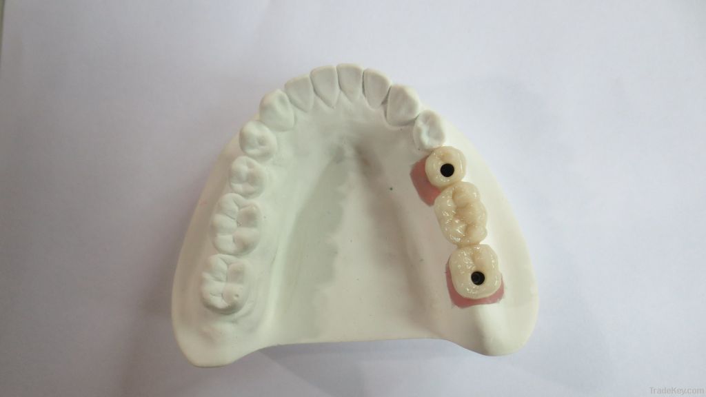 Dental implant