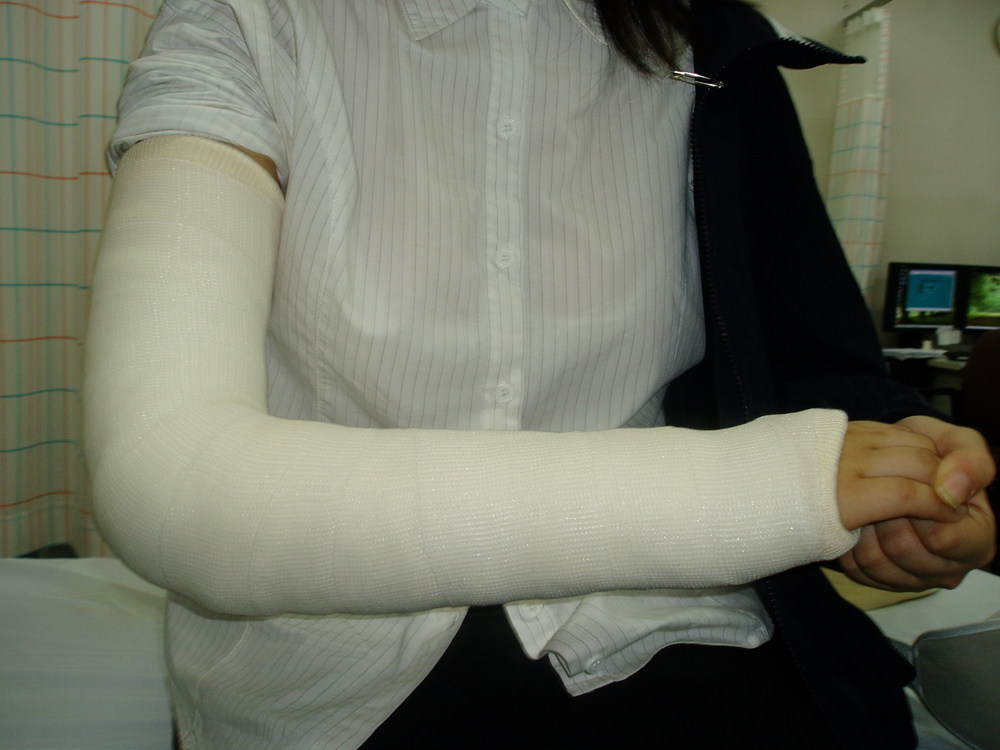orthopedic fiberglass medical  casting  bandage