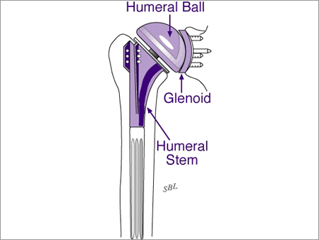 modular Bipolars prosthesis