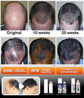 Herbal extract hair regrowth products prevent hair loss within a week