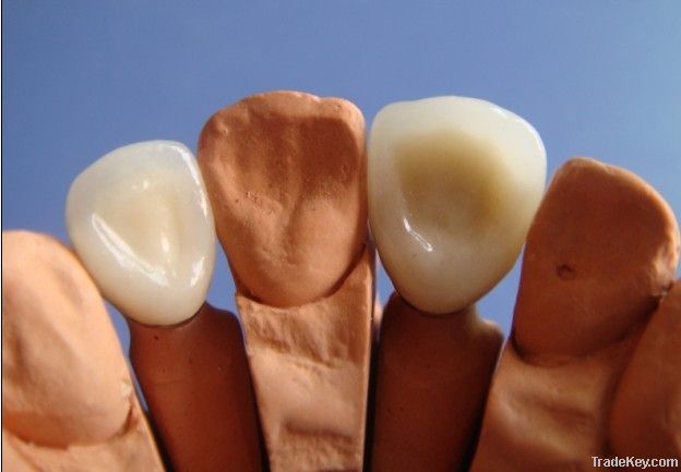 Dental Porcelain-fused-to-metal crown