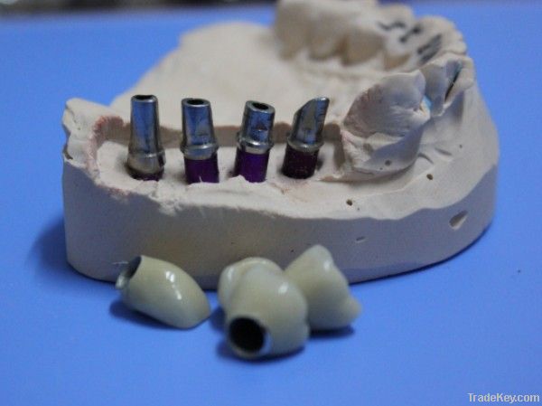 Dental implant PFM crown