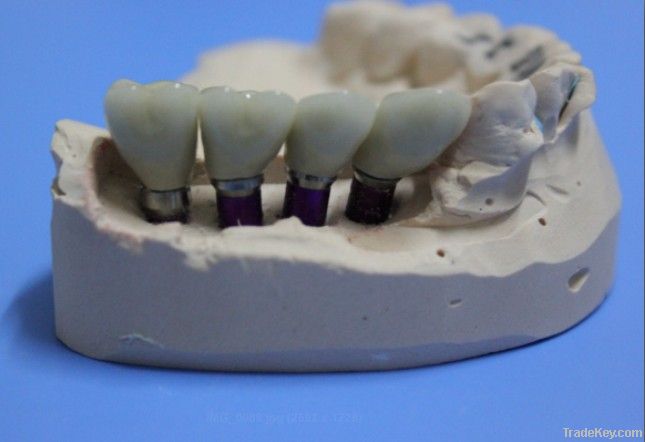 Dental implant PFM crown