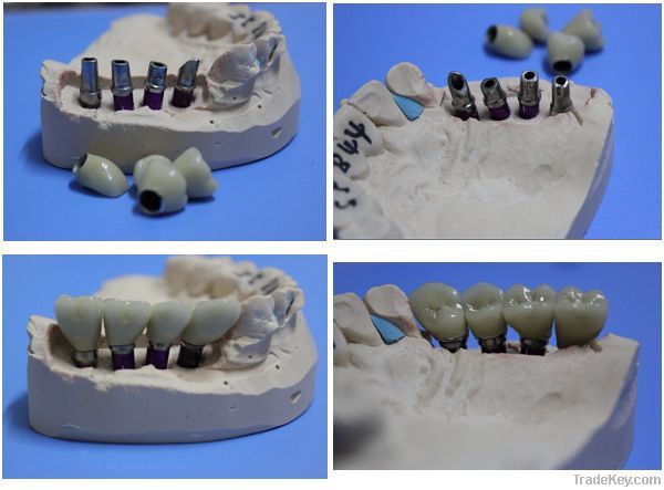 Dental implant PFM crown