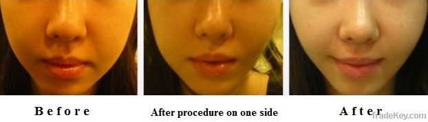 Medical facial lifting thread for plastic surgery