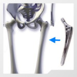 Rods Hip Prothesis