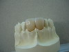 All ceramic restoration dental lab products