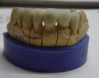 PFM CROWN AND BRIDGE dental lab products