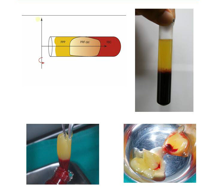 Prf Platelet Rich Fibrin