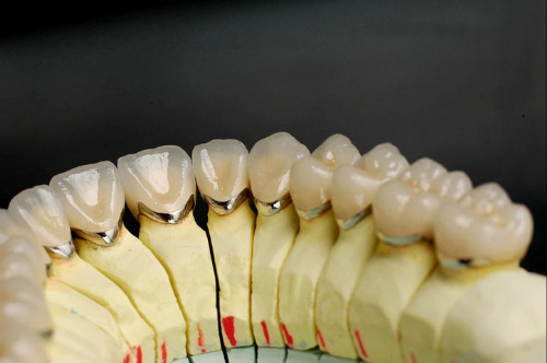 Dental porcelain fused to metal crown