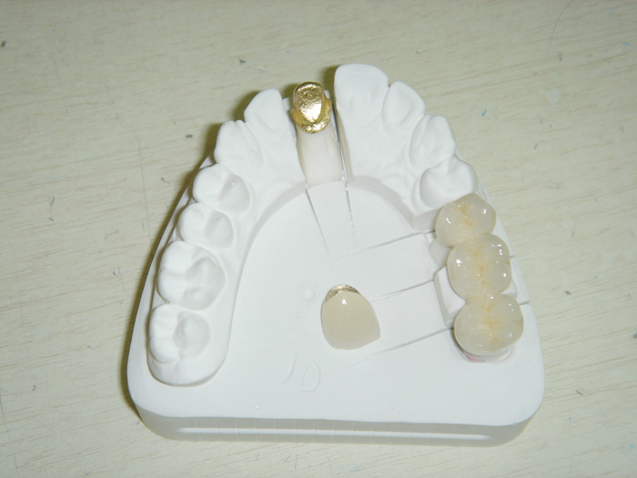 Dental captek crown