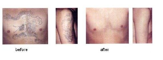 laser tattoo removal machine