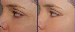 RF thermage wrinkle removal/facial lifting