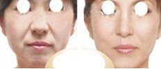 RF thermage wrinkle removal/facial lifting