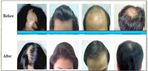 AES-GH8 (Hair growth/anti hair loss system)