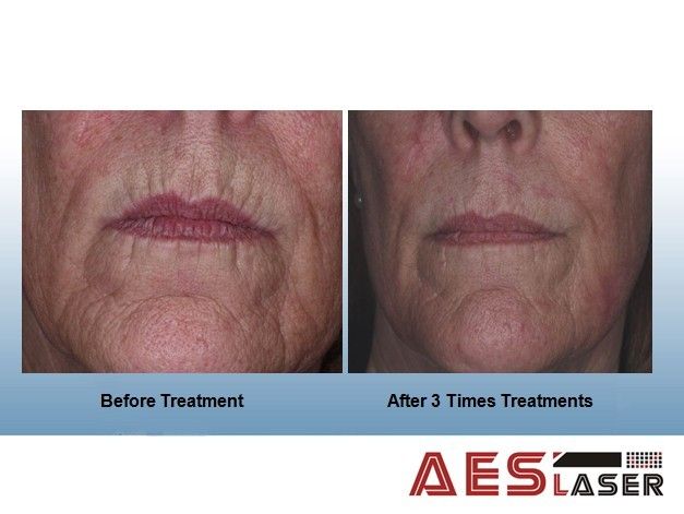 AES-IPL S308(IPL for Hair Removal, Vascular, Wrinkle, Sun spot, Age spot, Speckle, Acne, Skin rejuvenation, Skin whitening)