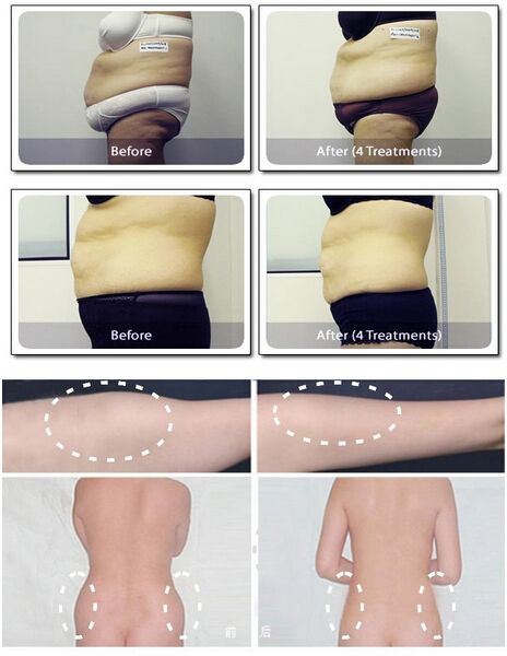 AES-LIPOLASER S(Lipolaser for body slimming, body sculping, body shaping, fat reduction, losing weight )