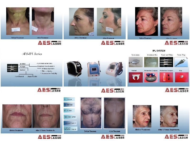 AES-IPL SPIRIT(IPL for Hair Removal, Vascular, Wrinkle, Sun spot, Age spot, Speckle, Acne, Skin rejuvenation, Skin whitening)