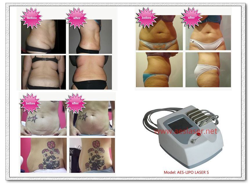 AES-LIPOLASER S (Lipolaser for body slimming, body sculping, body shaping, fat reduction, losing weight )