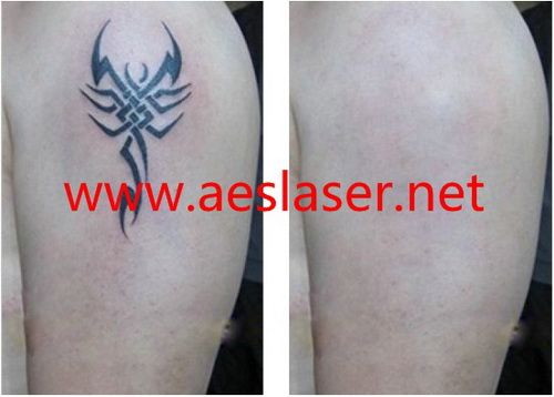 AES-LASER96(Q-Switched Nd-yag laser for tattoo removal, Medical Level machine with 2000MJ Energy! )