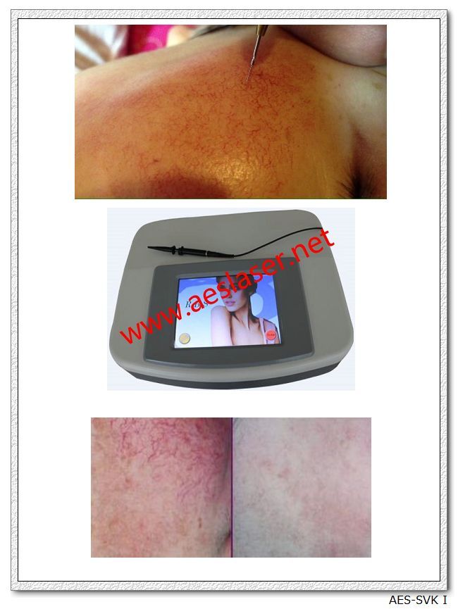 Fractional RF for Vascular and Spider Vein Removal