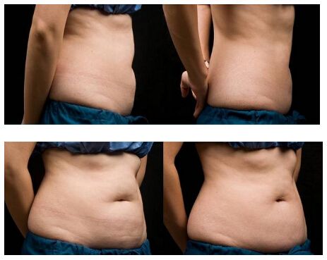 Cryolipolysis system for lose fat