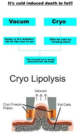 Cryolipolysis system for lose fat