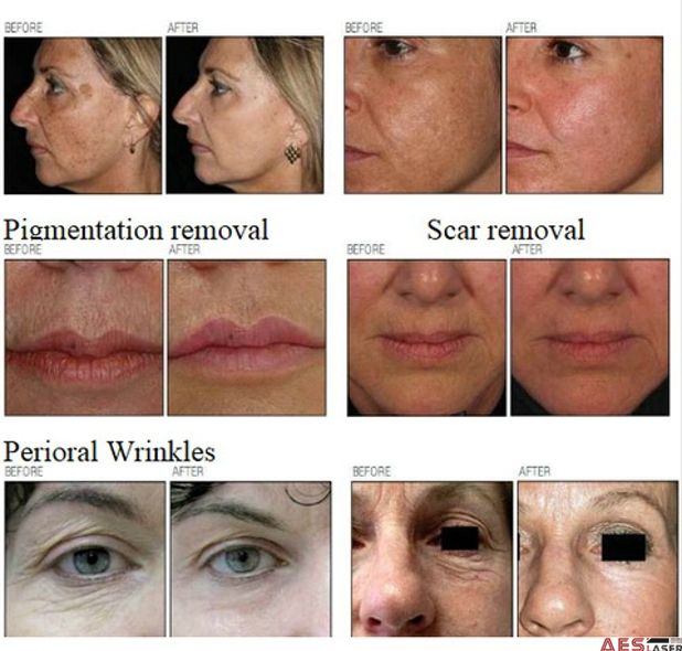 Thermage for Wrinkle removal