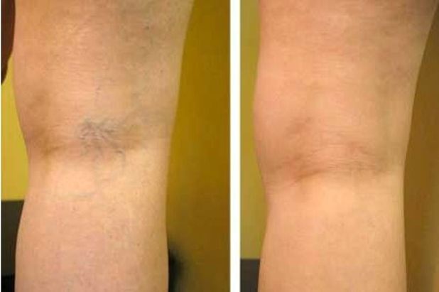 Fractional RF for Vascular and Spider Vein Removal