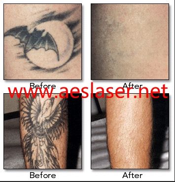 Q-Switched Nd-yag laser for tattoo removal