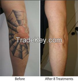 Q Switched ND-YAG laser for tattoo removal