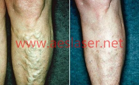 Vascular and Spider Vein Removal