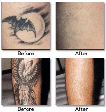 Q Switched ND-YAG laser for tattoo removal