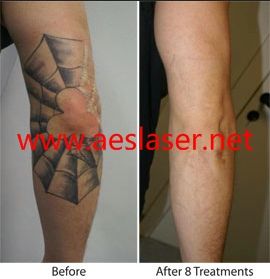 laser for tattoo removal