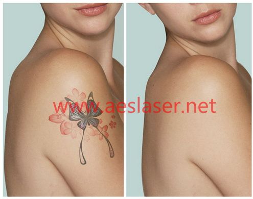 Q Switched ND-YAG laser for tattoo removal