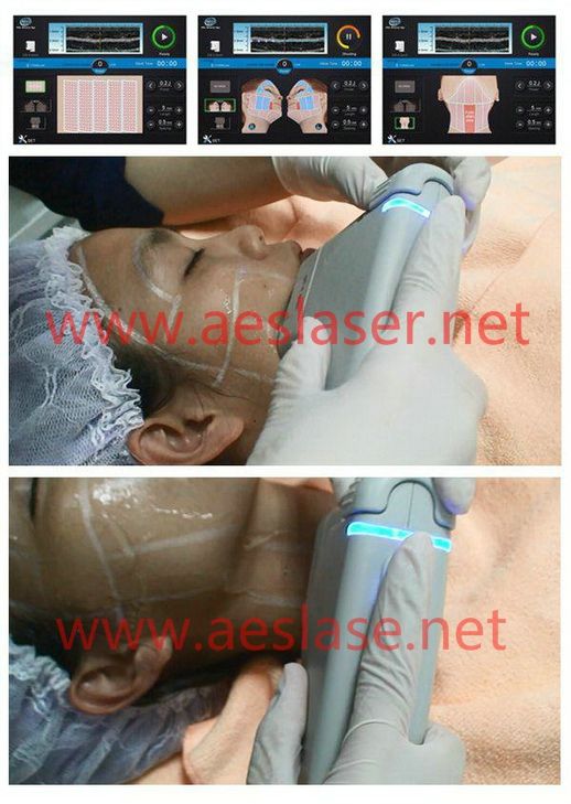 HIFU equipment for skin tight!