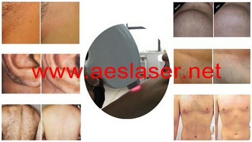 Hair removal by Diode Laser