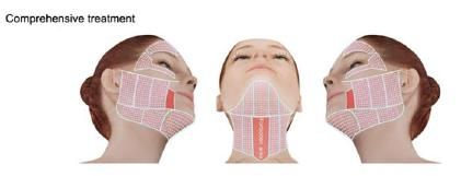 HIFU equipment for skin tight!