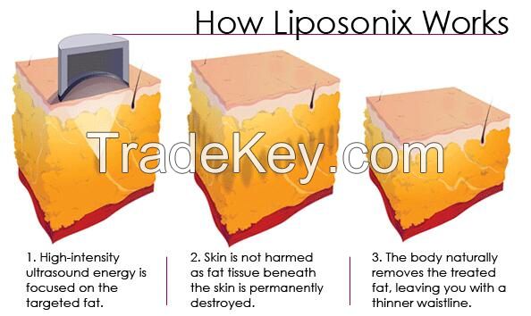 Liposonix HIFU technology body slimming machine