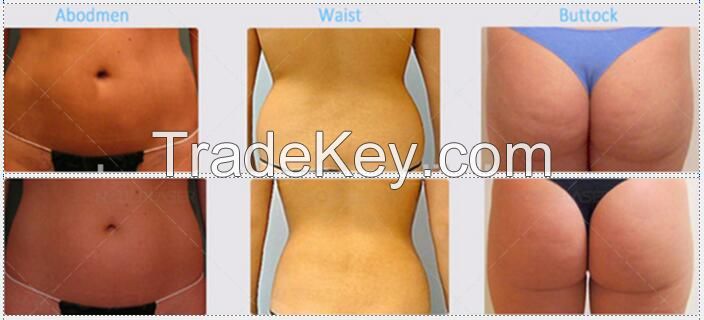 Liposonix HIFU technology body slimming machine