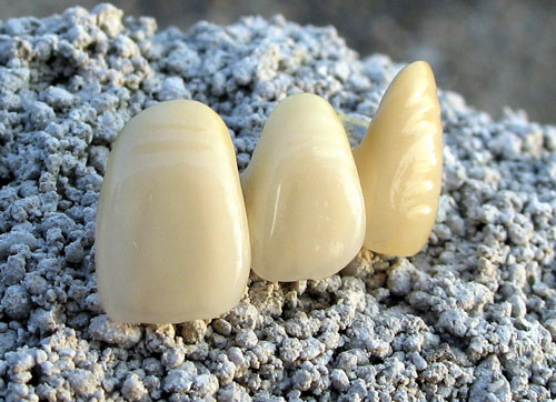 porcelain fused to metal false tooth