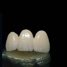 All-Ceramic(IPS ***** CAD) Crown&Bridge